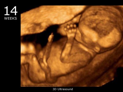 A 3d Ultrasound at just 15 weeks - See here.